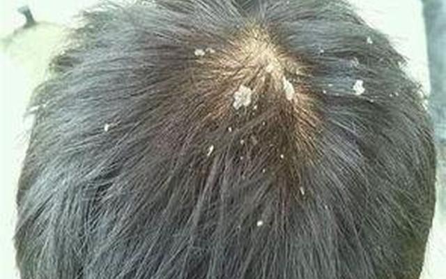 头皮屑多怎么办小妙招