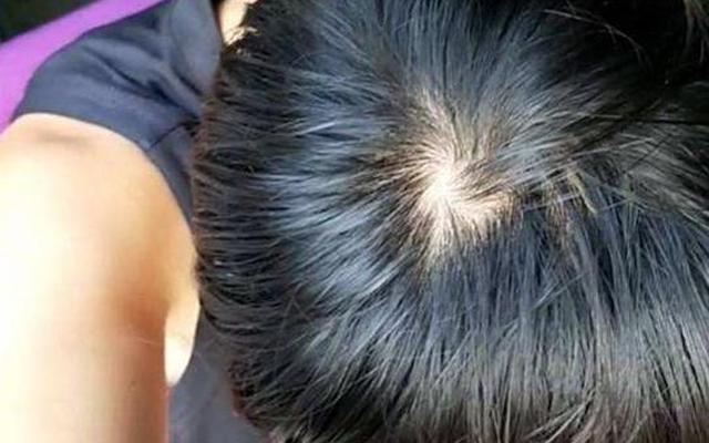 头发往下趴是什么原因