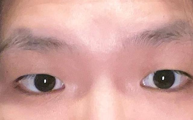 最丑的三种眼型