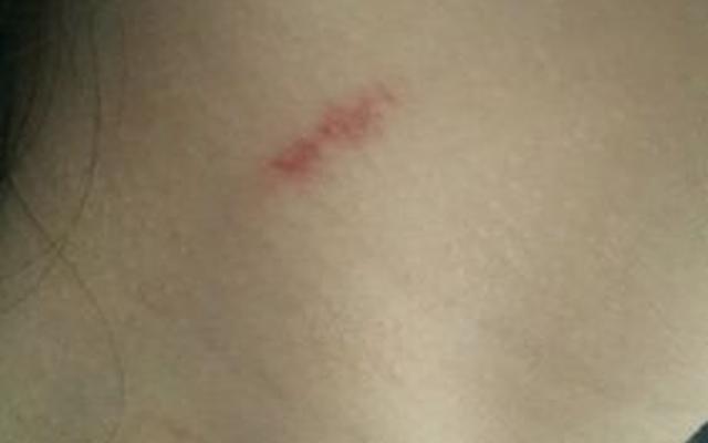 怎样快速去除脖子上的吻痕