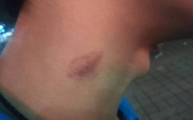 脖子吸的印子怎么快速去掉