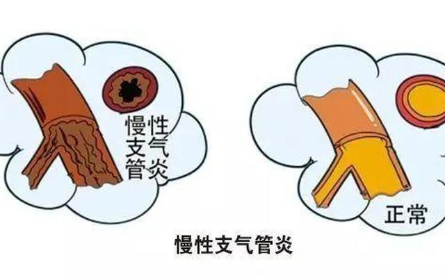 气管性支气管炎